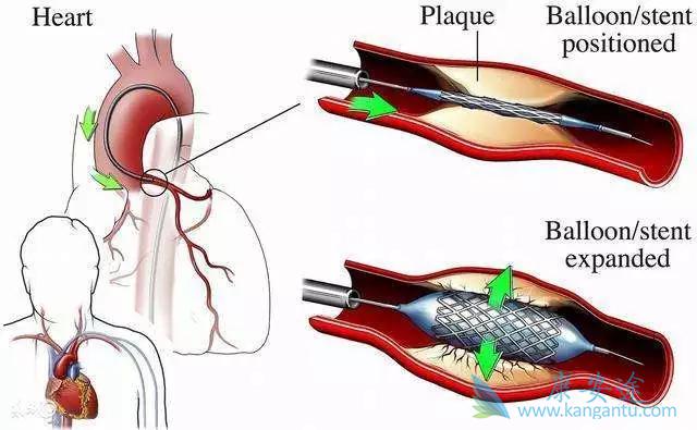心脏支架手术 心脏支架手术