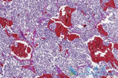 ��е����Ƽ���������(Cabozantinib)�������������ȸ�ϸ����