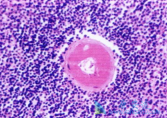 ���޻�(RITUXAN)������³���������ط��Ծ��򵰰�Ѫ֢Ч������