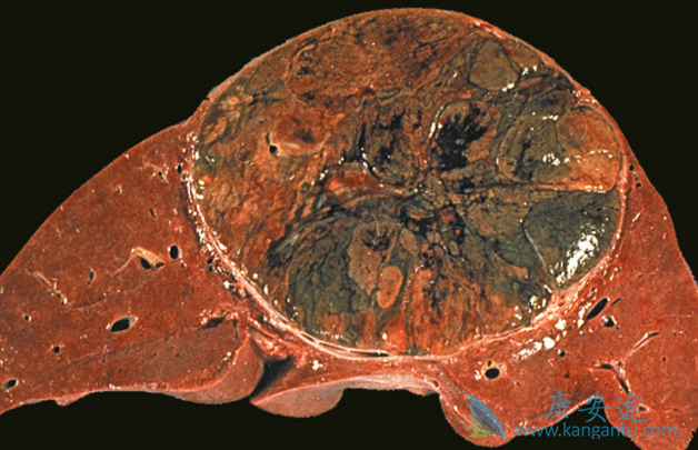乐伐替尼 乐伐替尼