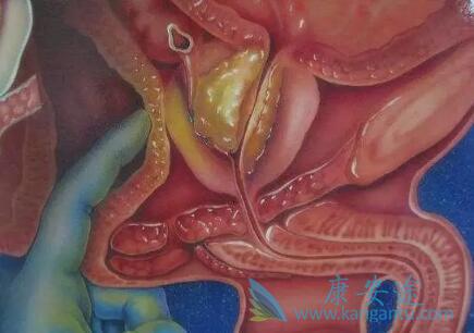 前列腺癌症状 前列腺癌症状