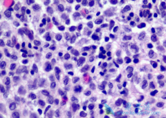 ���޷���(Vemurafenib)�ɸ���Erdheim-Chester�����ߵ�����