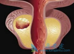 ����ҩ�ﰢ������(Zytiga)��������ǰ���ٰ���������