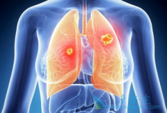 ����������ҩ�����ɫ������(Ceritinib)����Ч����ס������չ