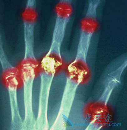 阿达木单抗 阿达木单抗