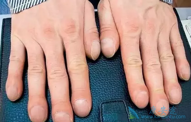 出现杵状指是否就是肺癌?杵状指是什么?【康安途海外医疗】
