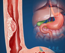 ���޿�(ERLOTINIB)���ϳ���������������ʳ�ܰ����ߵ���������