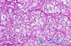 ��������(Olaparib)ʹ�ѳ������ߵļ�����չʱ���Ӻ��˽�����