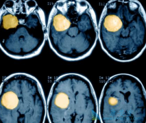 ��̹(sunitinib)����������Ĥ������Ч�ʿɴ�42%