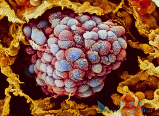 卡博替尼 卡博替尼