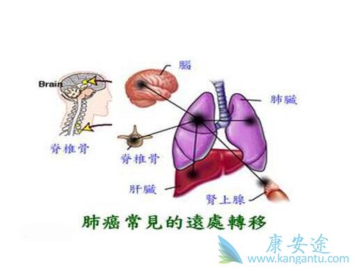 肺癌骨转移 肺癌骨转移