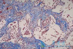 ������ͪ(pirfenidone)��������Щҩ��ͬʱ����