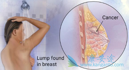 早期乳腺癌治疗 早期乳腺癌治疗