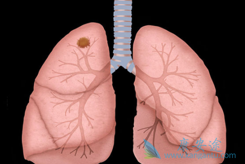 艾乐替尼 艾乐替尼