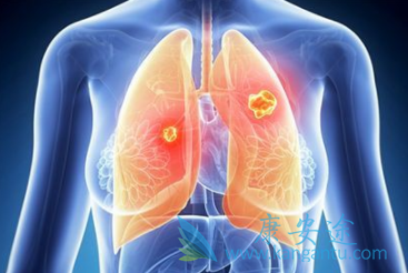 克唑替尼 克唑替尼