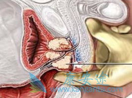 卡博替尼 卡博替尼