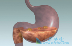 θ�������������߷��ø�����(Imatinib)Ҫע�������