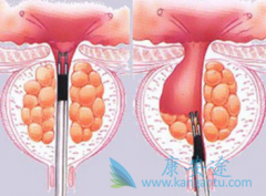 ��������(Zytiga)��ʹǰ���ٰ����ߵ�����ֹͣ����18����