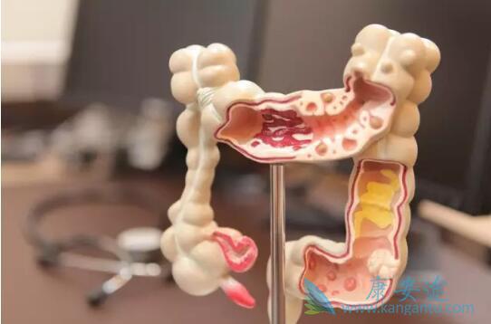 大肠癌症状 大肠癌症状