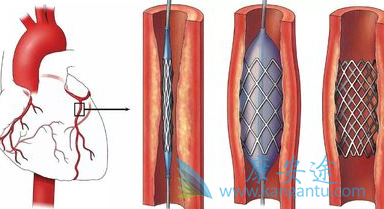 心脏支架 心脏支架