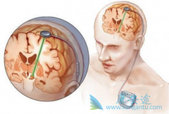 �����԰����Բ��ķ���ԭ���֢״����