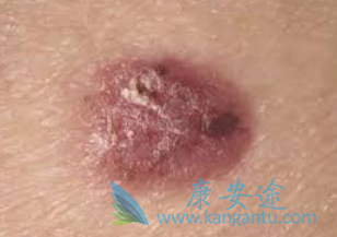 基底细胞癌 基底细胞癌