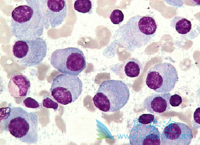 多发性骨髓瘤 多发性骨髓瘤