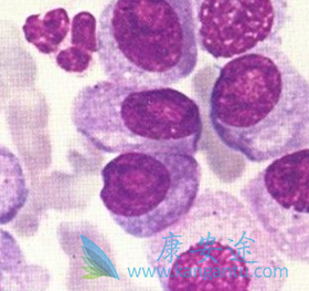 多发性骨髓瘤 多发性骨髓瘤