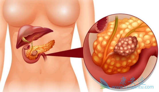 胰腺癌的治疗 胰腺癌的治疗