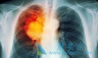 非小细胞肺癌 非小细胞肺癌