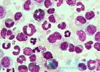 慢性粒细胞白血病 慢性粒细胞白血病