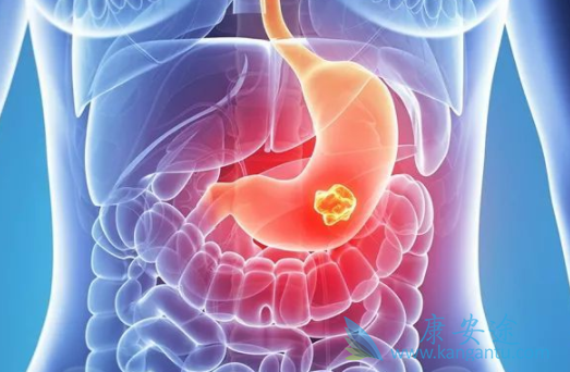 胃肠道间质瘤 胃肠道间质瘤