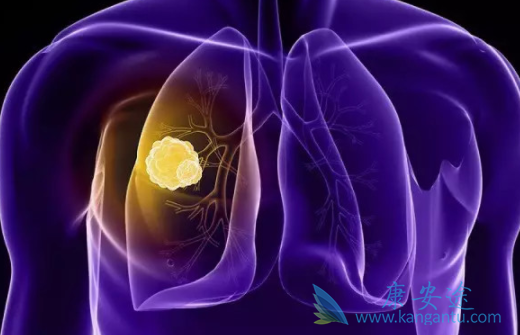 肺癌放疗 肺癌放疗