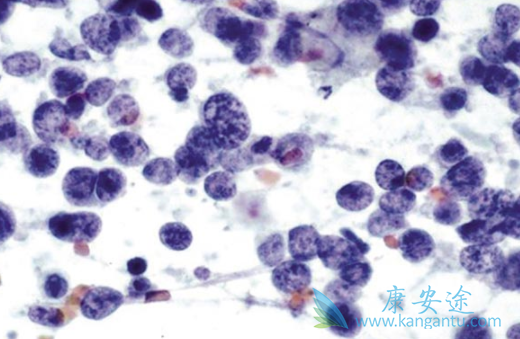 小细胞肺癌 小细胞肺癌