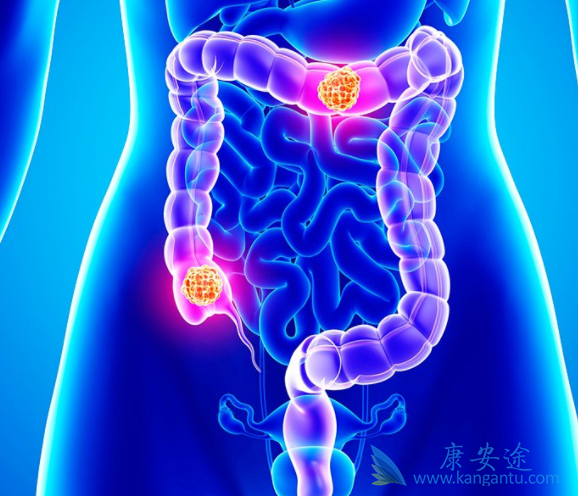 结直肠癌 结直肠癌