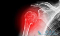 ��������(Cometriq)���������������͹�������ʾ�ϸߵĿ���������