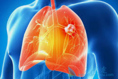 �����鵥������EGFR-TKI��ΪEGFRͻ�����Ի��߻��ߵ�һ����ѡ��