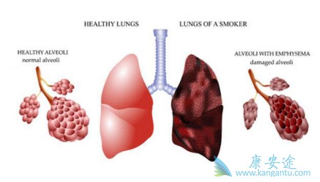 肺癌放疗副作用 肺癌放疗副作用