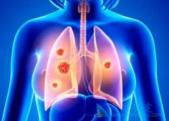 PD-L1�������50%�ķΰ�����һ�߷����Ƽ�PD1����