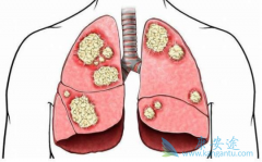 �ϲ���ת�Ƶ�EGFRͻ���Сϸ���ΰ���ѡ����ҩ�ﻹ����������