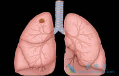 ��������(Lorlatinib)����ROS1���Ի���Ч��������ô����