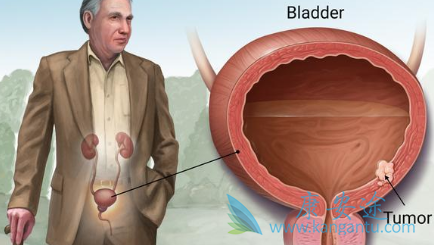 膀胱癌患者 膀胱癌患者
