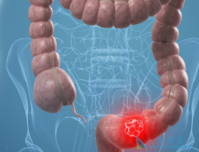 结直肠癌 结直肠癌