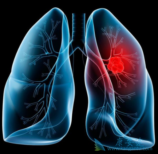 晚期肺癌 晚期肺癌