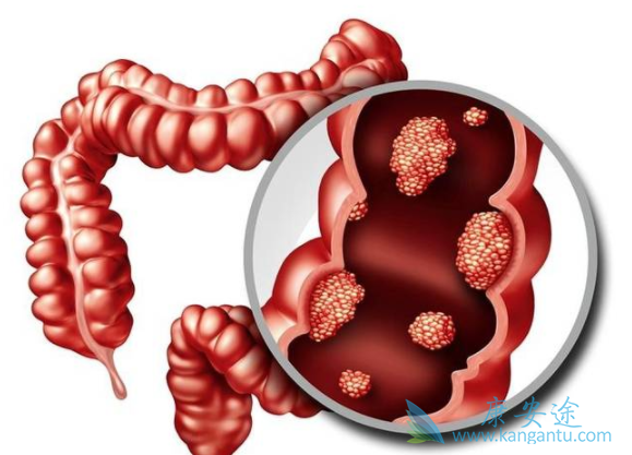 大肠癌症状 大肠癌症状