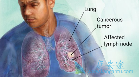NSCLC
