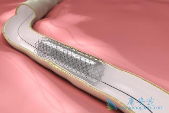 心脏支架 心脏支架