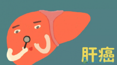 ��������(Cabometyx)��ŷ�˻����������ڸΰ�