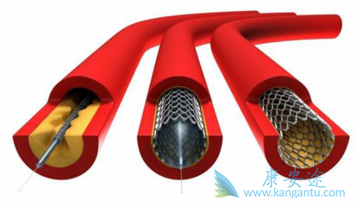 心脏支架 心脏支架