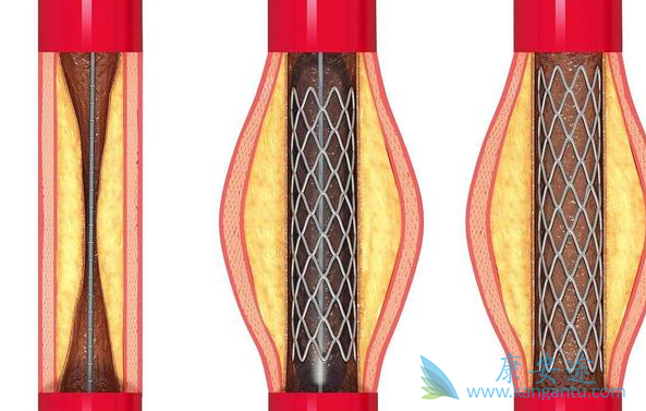 心脏支架 心脏支架